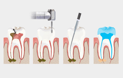 Endodontik Tedavi(Kanal Tedavisi)